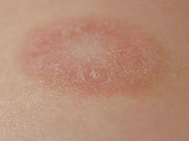 Pityriasis Rosea