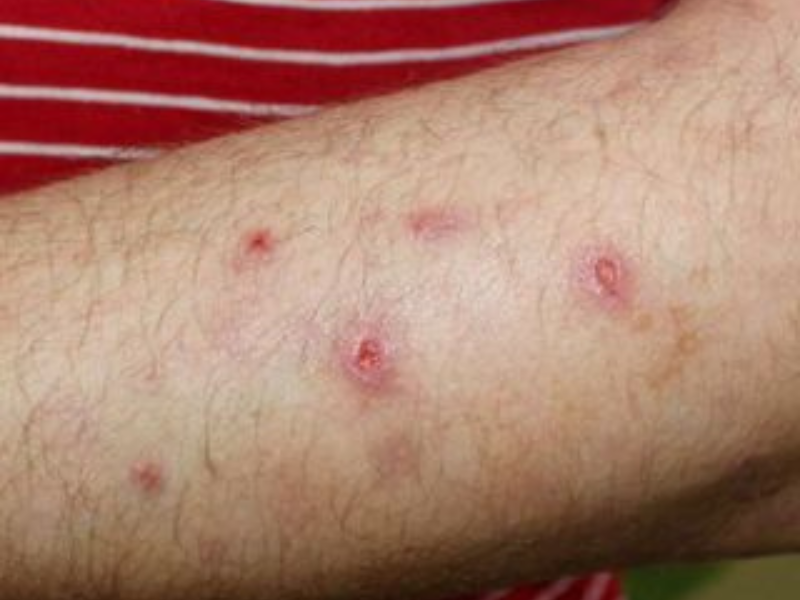 Prurigo Nodularis