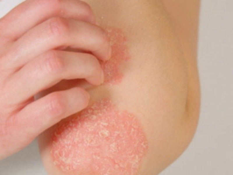 Psoriasis