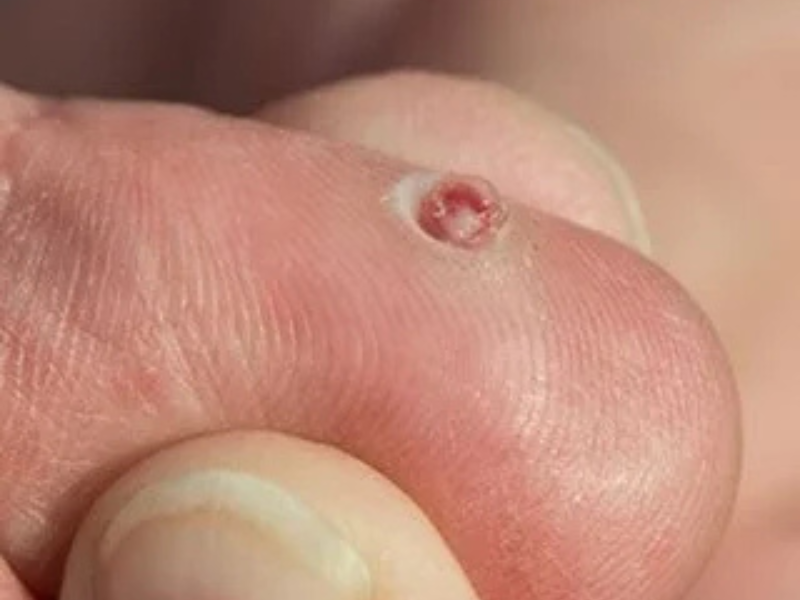Pyogenic Granuloma