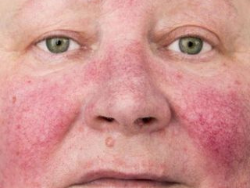 Rosacea