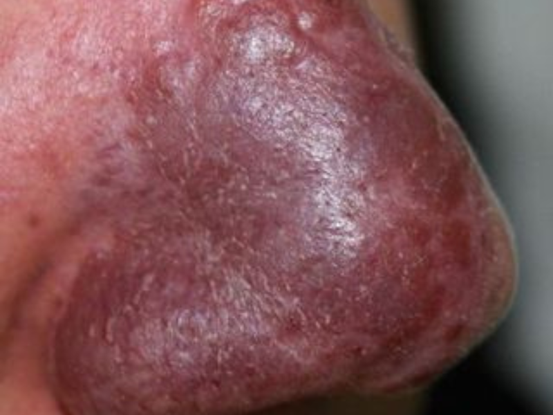 Sarcoidosis