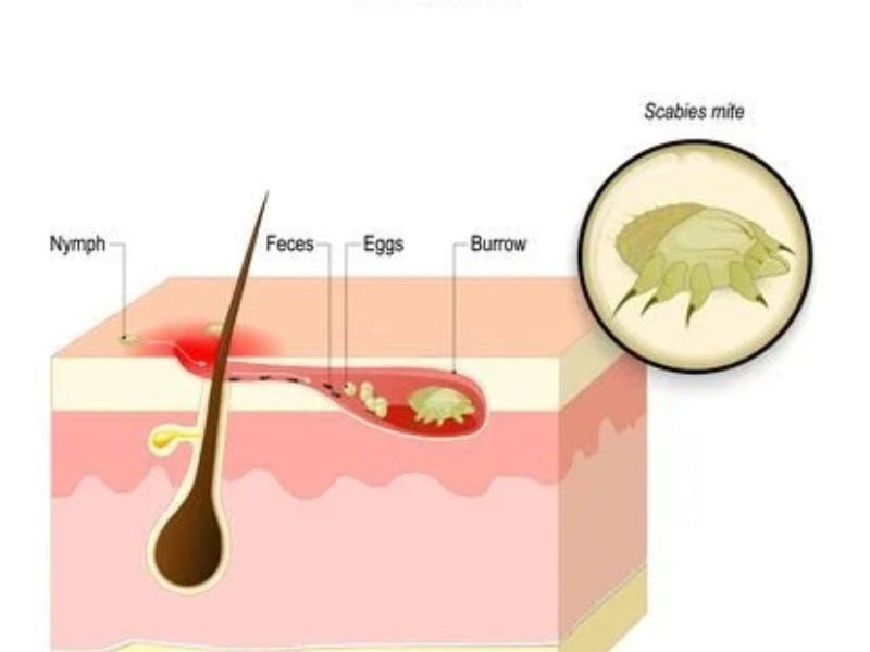 Scabies