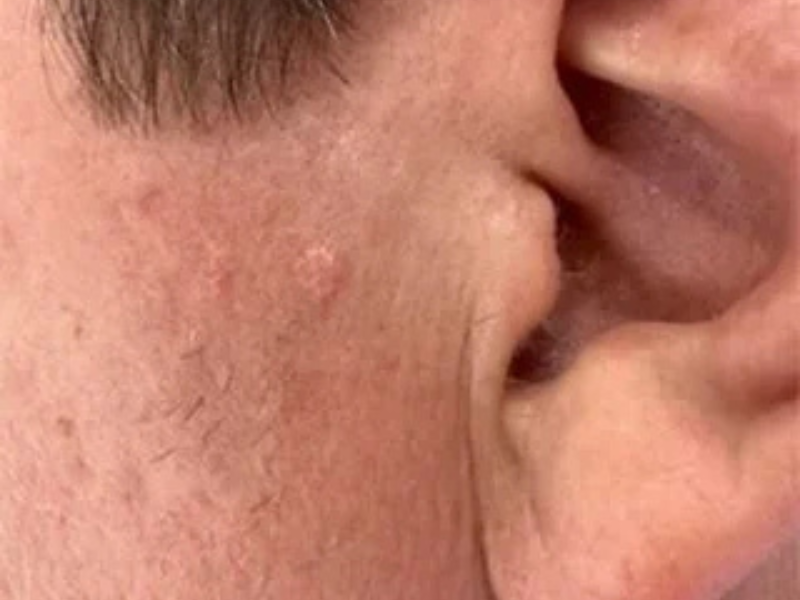 Sebaceous Hyperplasia