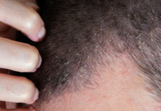 Seborrheic Dermatitis