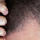 Seborrheic Dermatitis