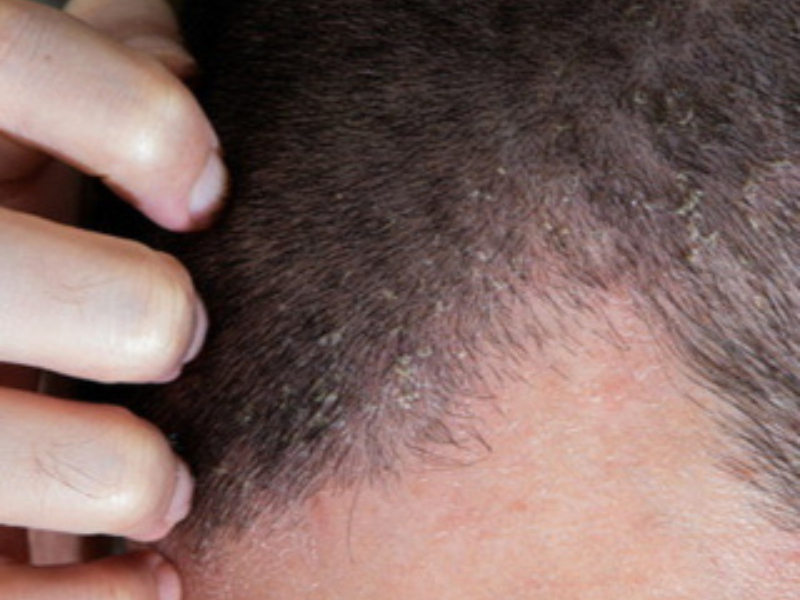 Seborrheic Dermatitis