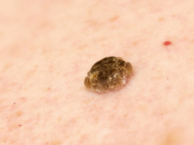Seborrheic Keratoses