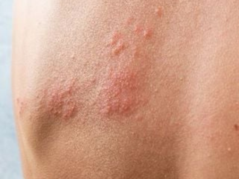Shingles (Herpes Zoster)