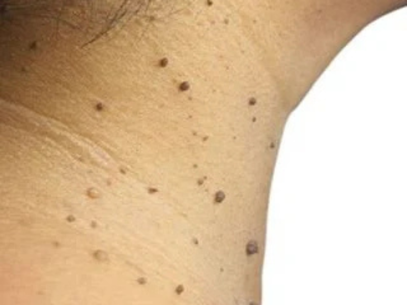 Skin Tags