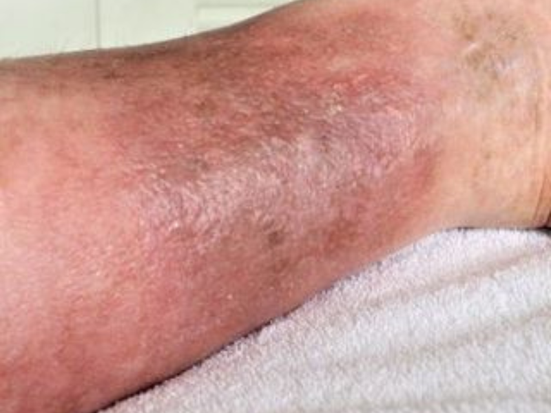 Stasis Dermatitis