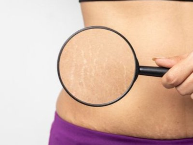 Stretch Marks (Striae)