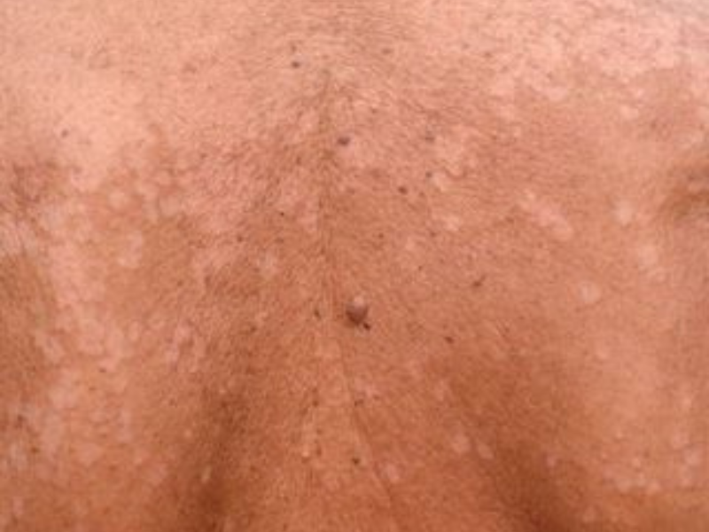 Tinea Versicolor