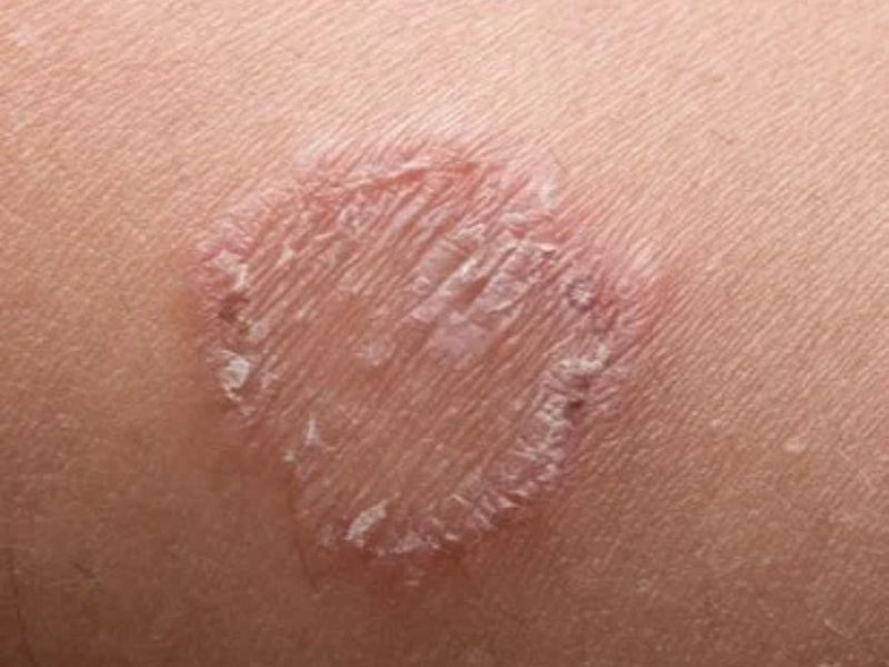 Tinea