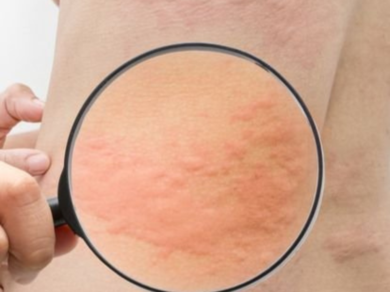 Urticaria (Hives)