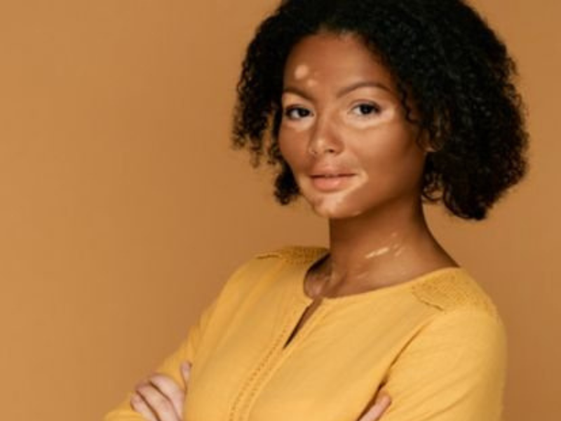 Vitiligo