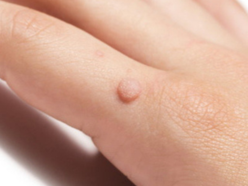 Warts