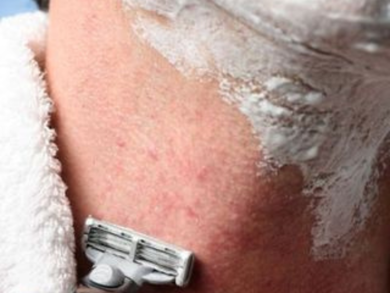 pseudofolliculitis barbae